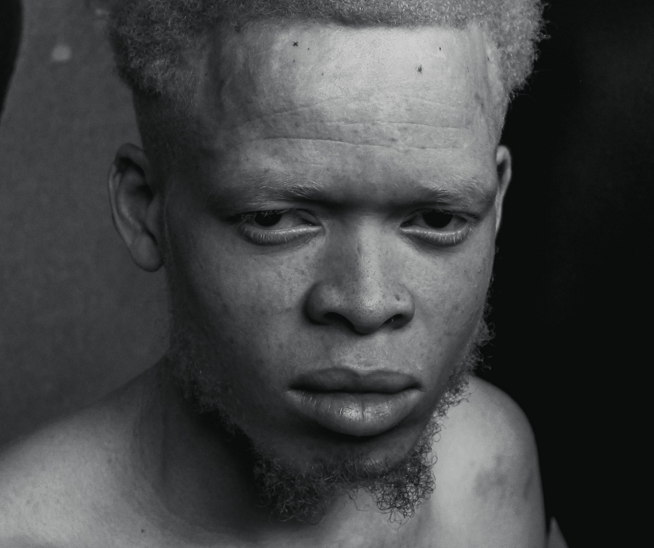 Pessoas albinas