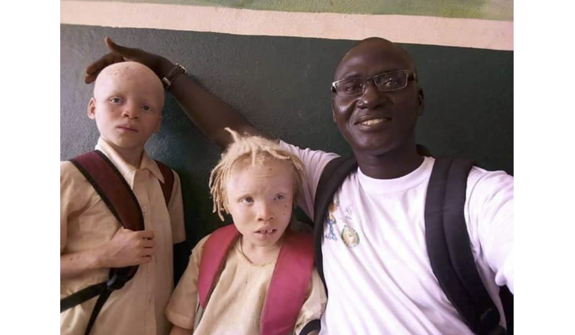 Evento sobre albinismo