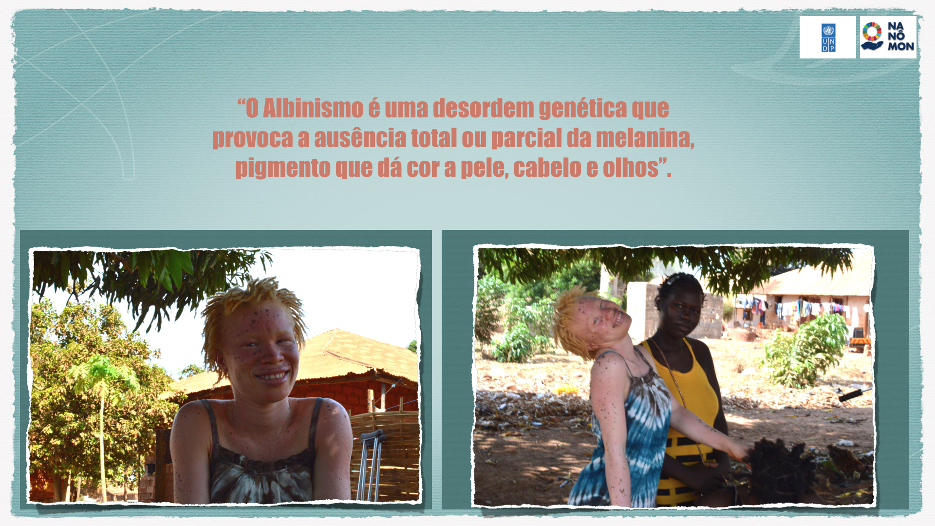 Dia Internacional do Albinismo