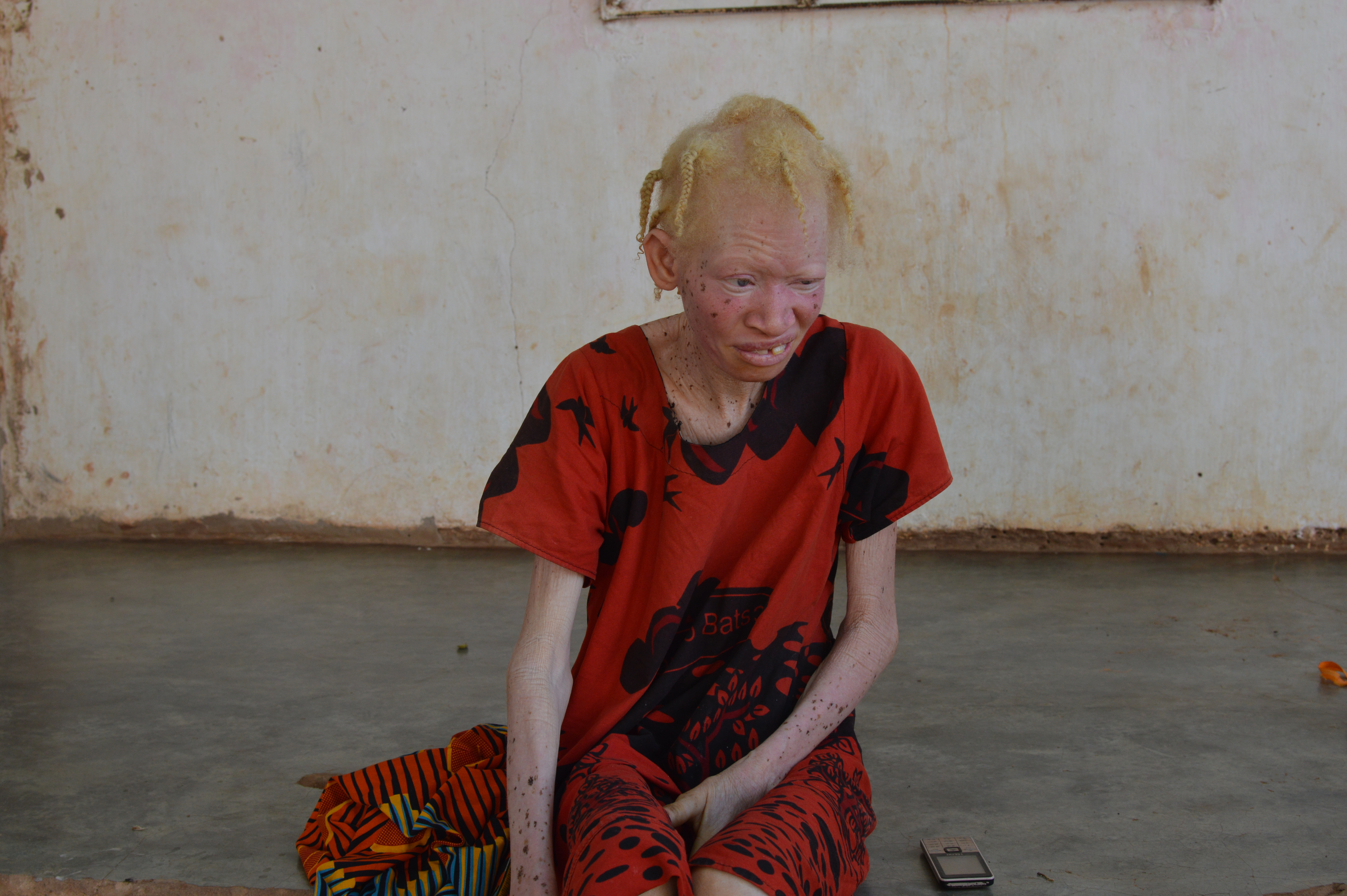Projecto sobre albinismo 